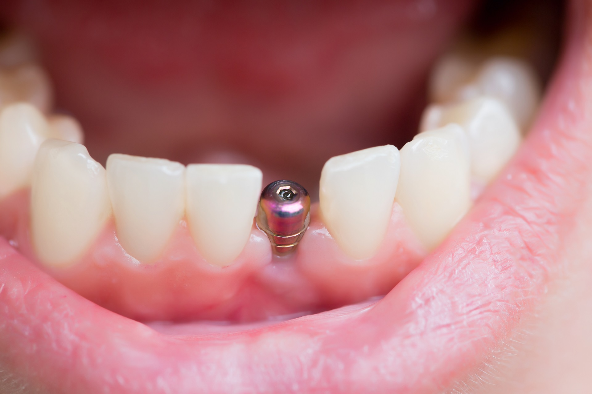 one visit tooth implant